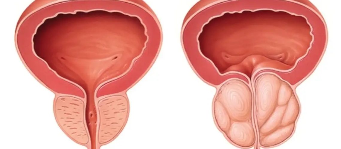 التهاب پروستات